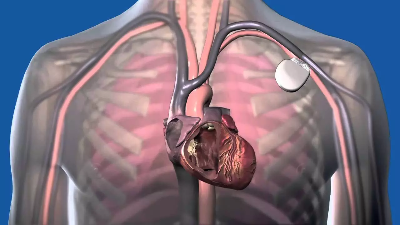 AICD Implantation in Agra