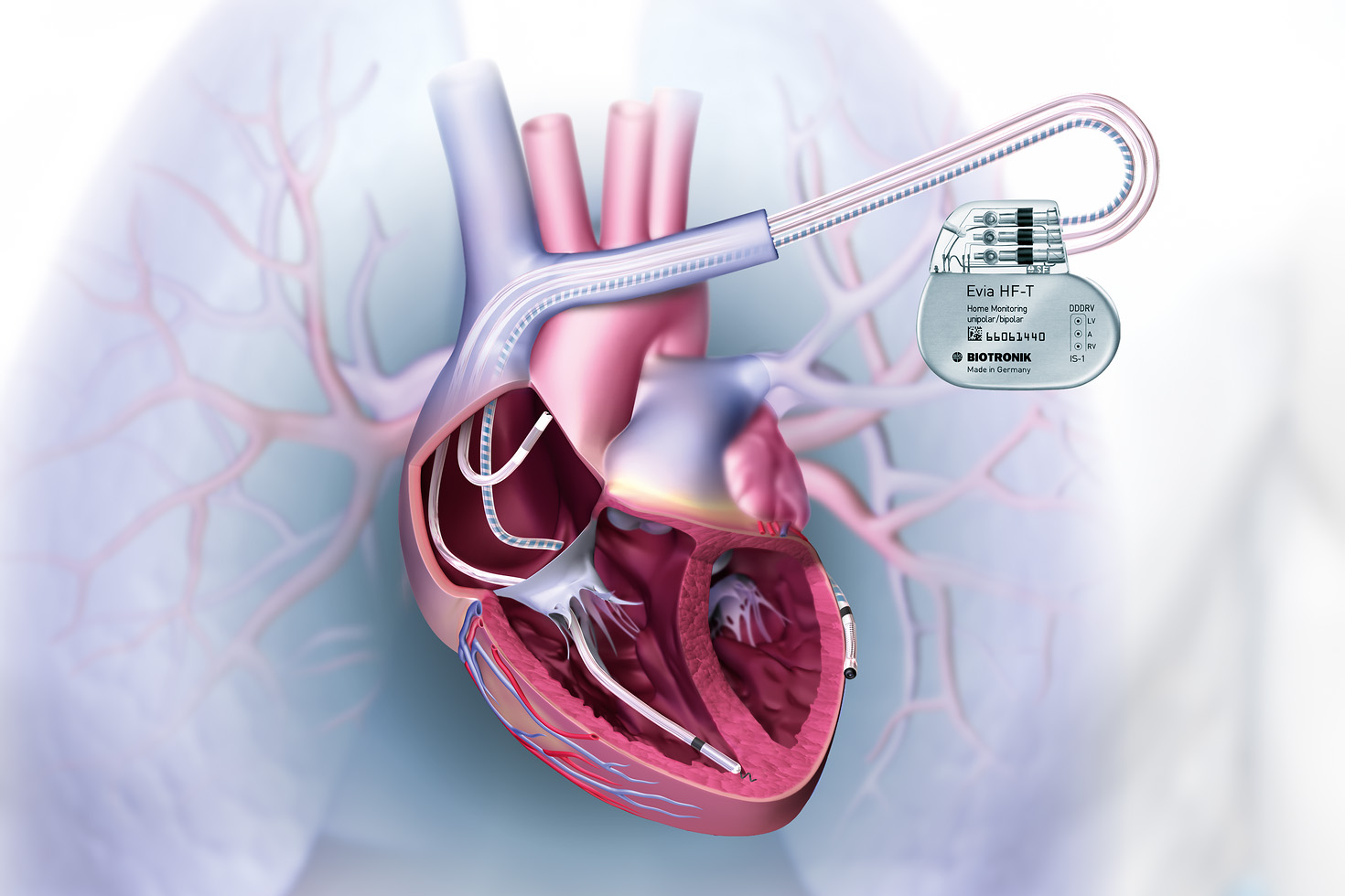 CRTD Implantation in Agra