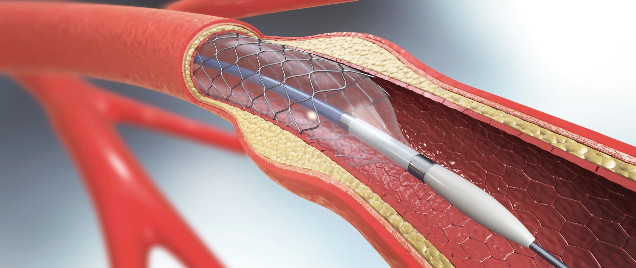 Cardiac Catheterization in Agra