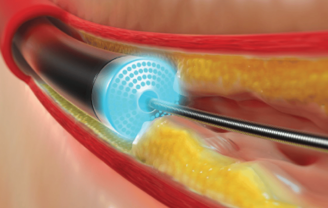 Angioplasty Treatment in Agra