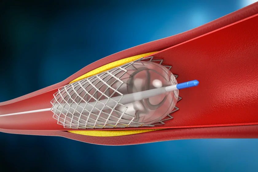 Peripheral Angiography/Angioplasty